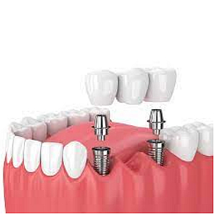 Implantes de dientes